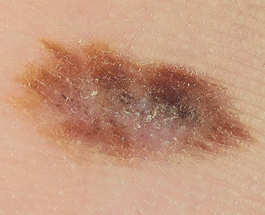 меланома кожи - лечение в онкологических центрах Германии