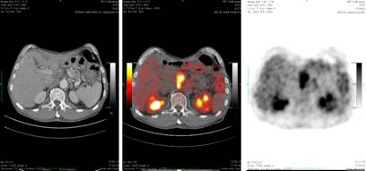 позитронная эмиссионная томография при раке поджелудочной железы