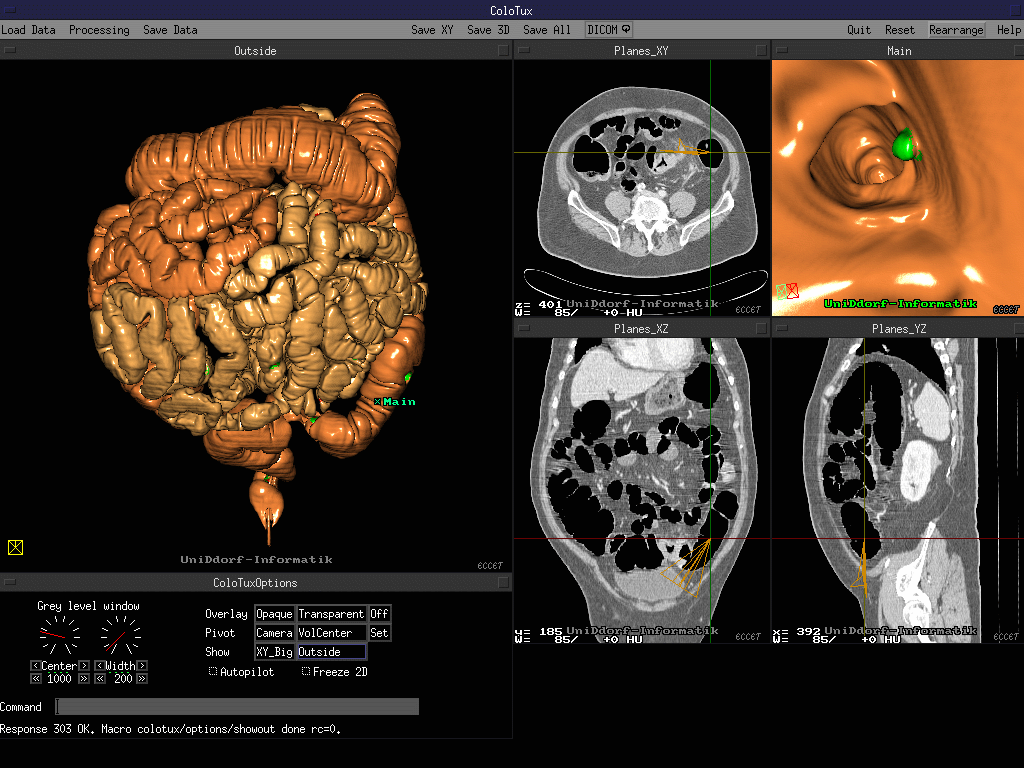 Виртуальная бронхоскопия в диагностических центрах Германии