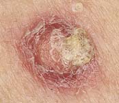 Плоскоклеточный рак кожи - белизна, трещины