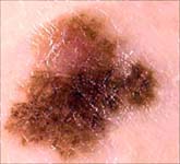 Плоскоклеточный рак кожи - в виде родимого пятна