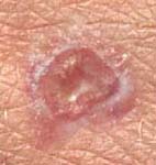Базальноклеточный рак кожи в виде незатягивающейся раны